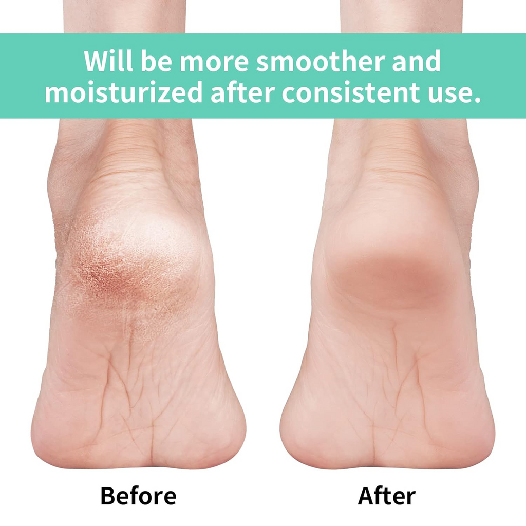 Silicone Gel Heel Socks – Cracked Heels Remedy | Velvet Wheels - 3