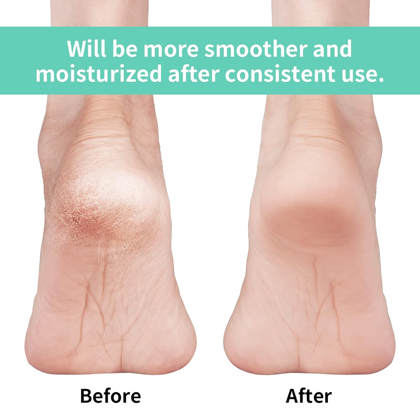 Silicone Gel Heel Socks – Cracked Heels Remedy | Velvet Wheels - 3
